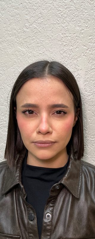 Resultado depois de procedimento estético na EZ Aesthetics & Wellness, Orlando — caso 1