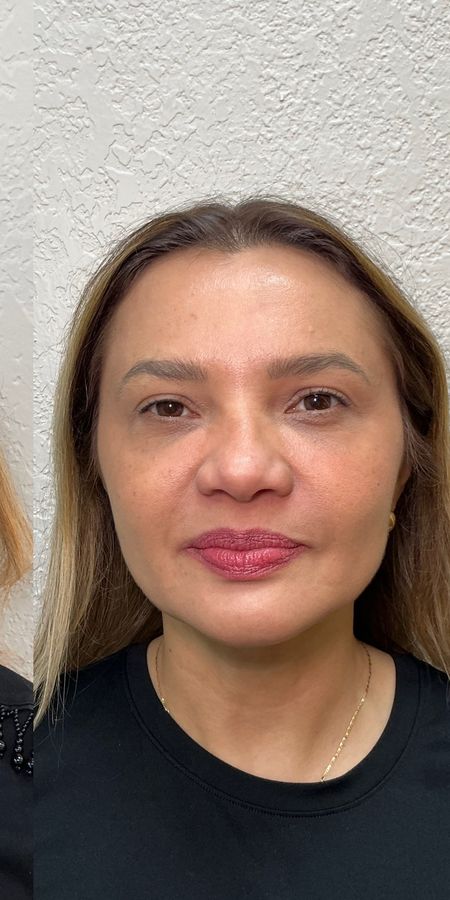 Resultado depois de procedimento estético na EZ Aesthetics & Wellness, Orlando — caso 11