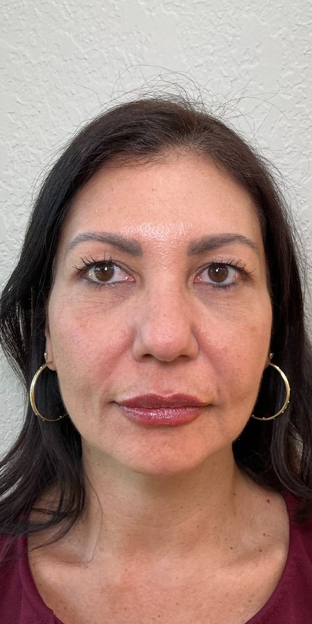 Resultado depois de procedimento estético na EZ Aesthetics & Wellness, Orlando — caso 12