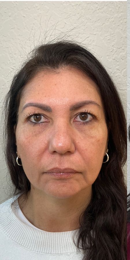 Antes do procedimento estético — caso 12 da EZ Aesthetics & Wellness, Orlando