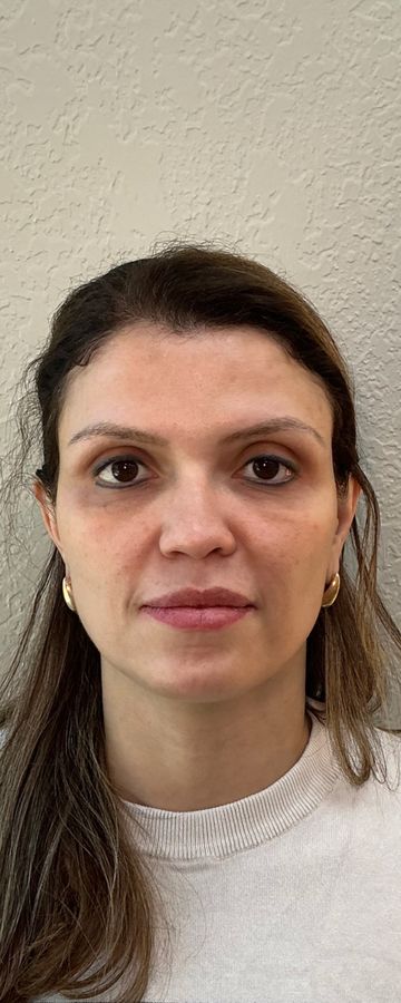 Resultado depois de procedimento estético na EZ Aesthetics & Wellness, Orlando — caso 13