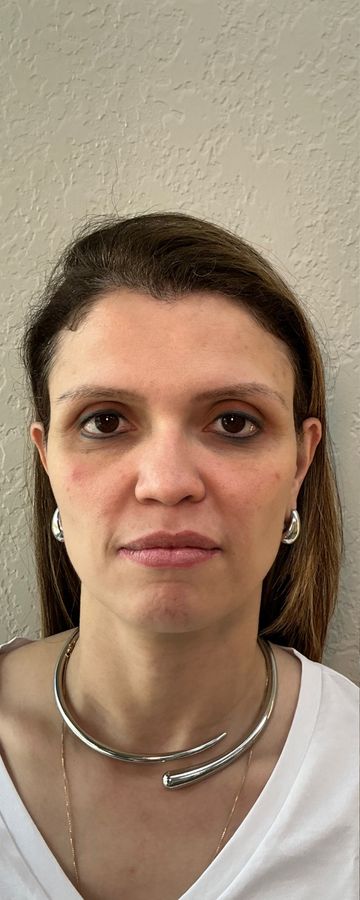 Antes do procedimento estético — caso 13 da EZ Aesthetics & Wellness, Orlando