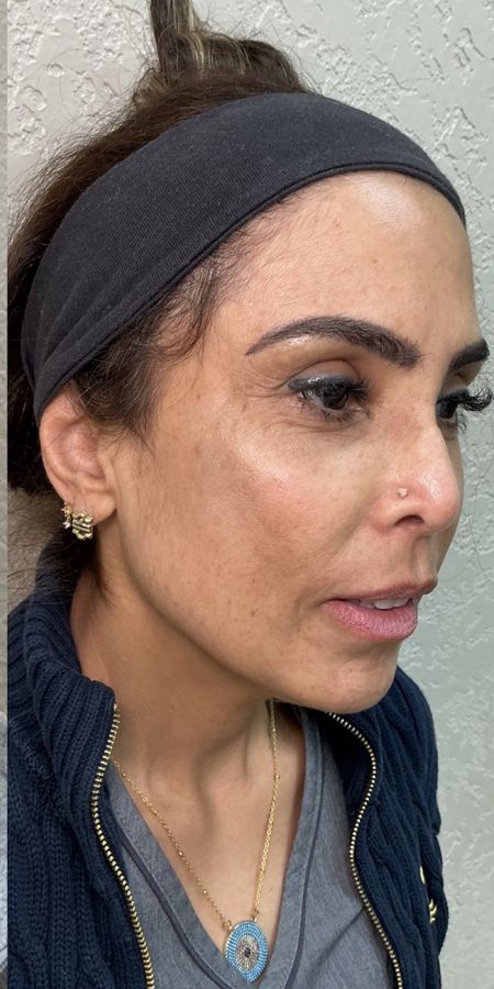 Resultado depois de procedimento estético na EZ Aesthetics & Wellness, Orlando — caso 14