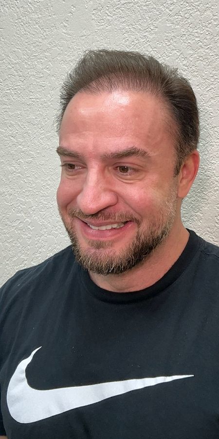 Resultado depois de procedimento estético na EZ Aesthetics & Wellness, Orlando — caso 15