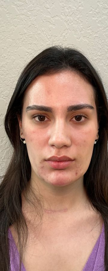 Resultado depois de procedimento estético na EZ Aesthetics & Wellness, Orlando — caso 16