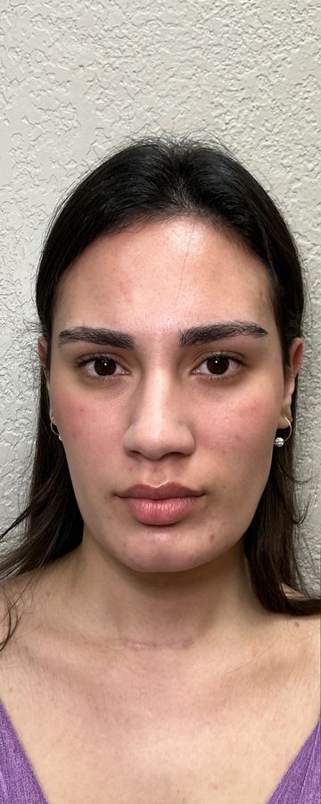 Antes do procedimento estético — caso 16 da EZ Aesthetics & Wellness, Orlando
