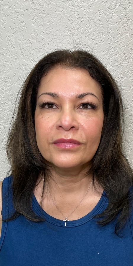 Resultado depois de procedimento estético na EZ Aesthetics & Wellness, Orlando — caso 17
