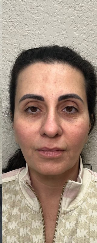 Resultado depois de procedimento estético na EZ Aesthetics & Wellness, Orlando — caso 5