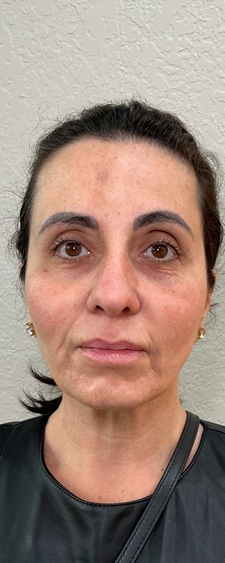 Antes do procedimento estético — caso 5 da EZ Aesthetics & Wellness, Orlando