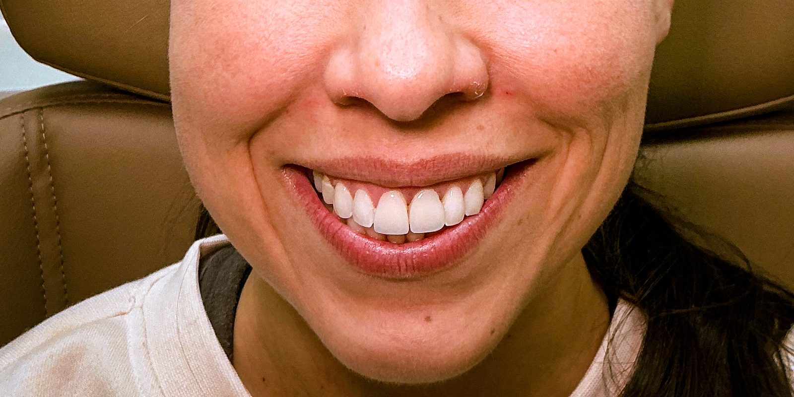 Resultado depois de procedimento estético na EZ Aesthetics & Wellness, Orlando — caso 6