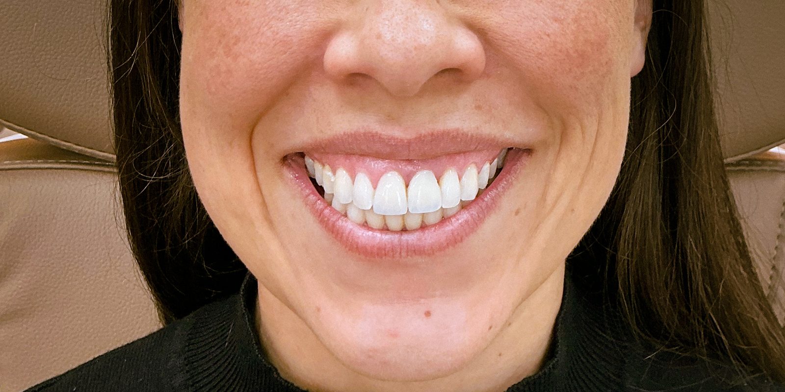 Antes do procedimento estético — caso 6 da EZ Aesthetics & Wellness, Orlando