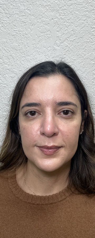 Resultado depois de procedimento estético na EZ Aesthetics & Wellness, Orlando — caso 8