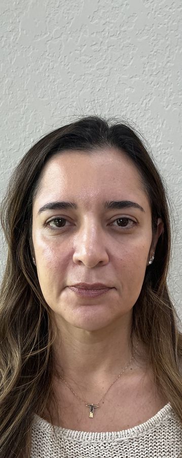 Antes do procedimento estético — caso 8 da EZ Aesthetics & Wellness, Orlando