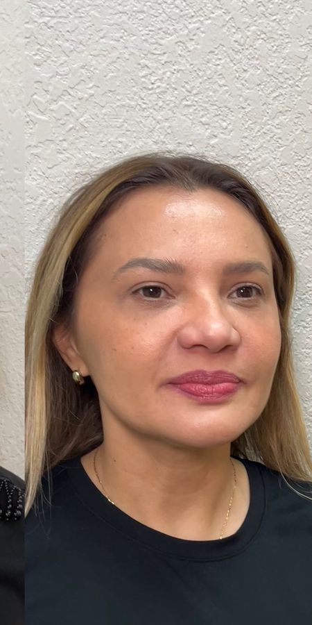 Resultado depois de procedimento estético na EZ Aesthetics & Wellness, Orlando — caso 9