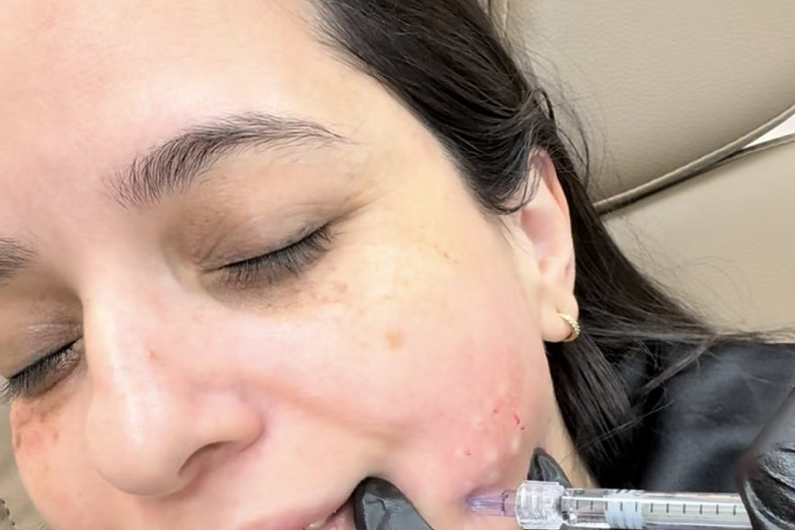 Aplicação de mesoterapia facial em Orlando na clínica EZ Aesthetics & Wellness