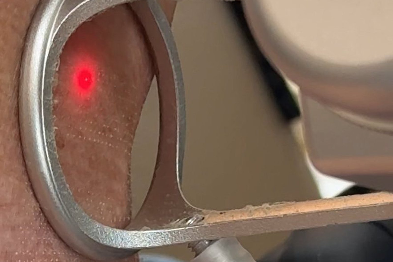 Procedimento de radiofrequência fracionada em Orlando realizado na EZ Aesthetics & Wellness