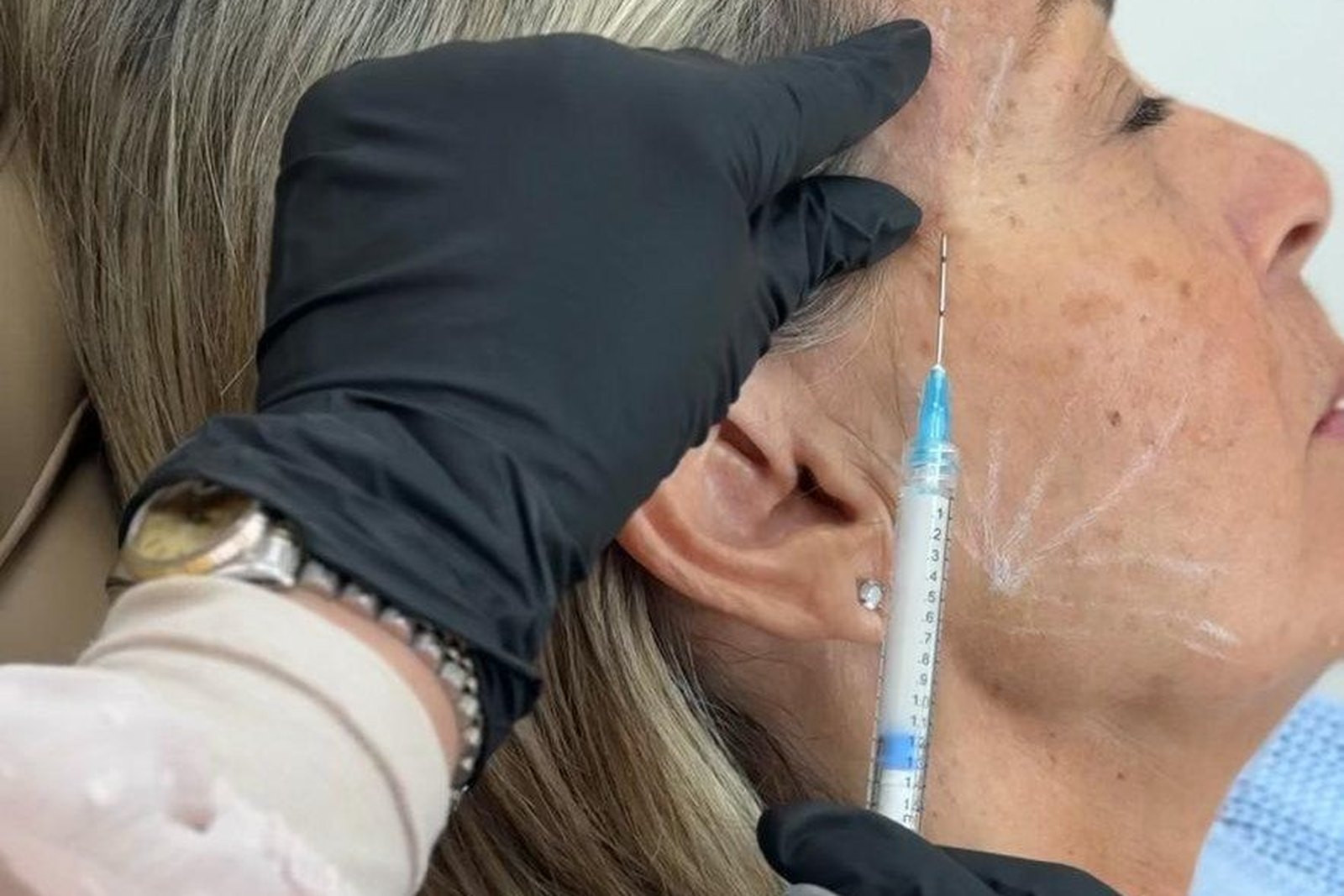 Aplicação de Sculptra bioestimulador de colágeno em clínica de medicina estética em Orlando