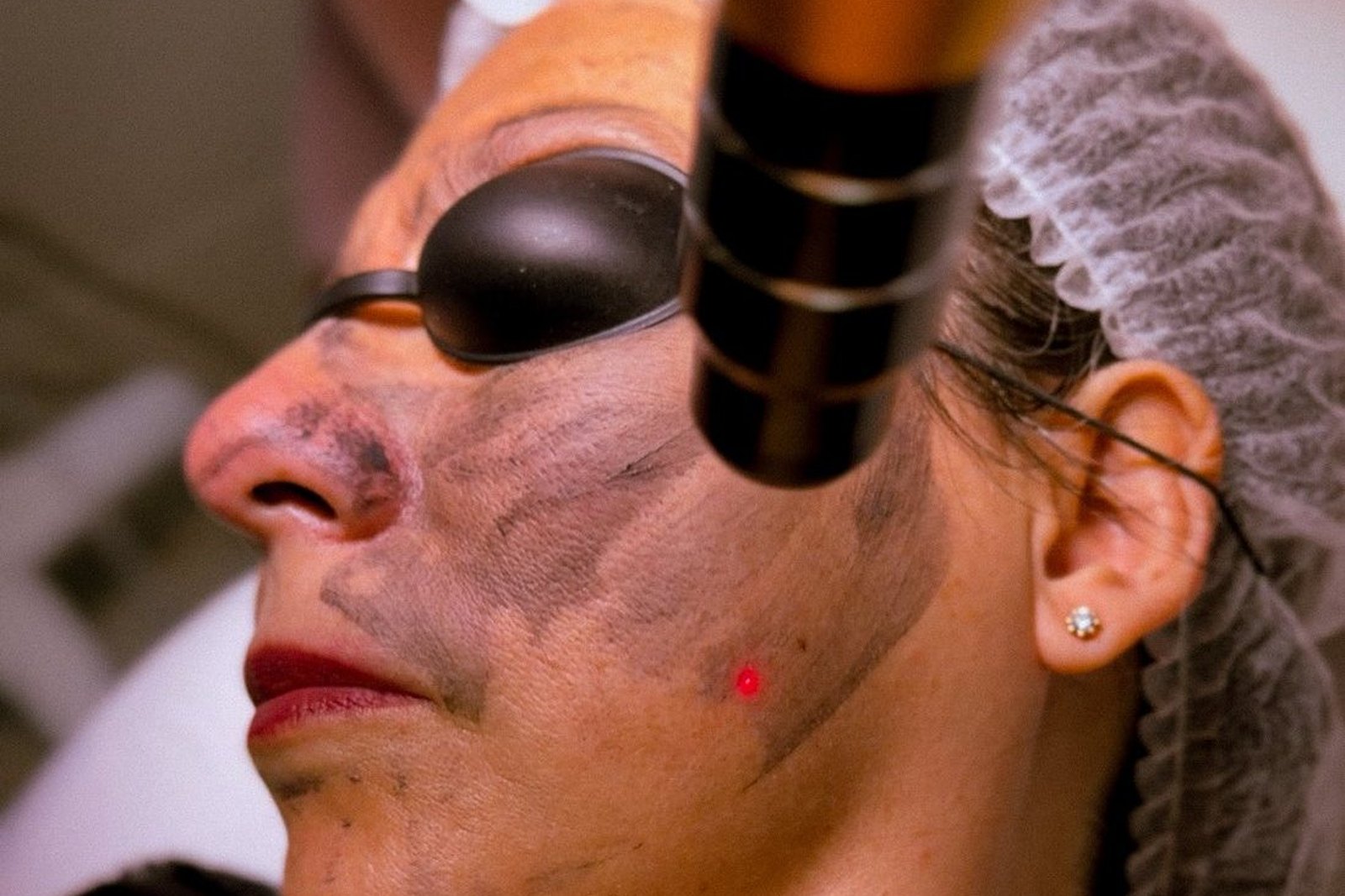 Aplicação de peeling químico em Orlando na clínica EZ Aesthetics & Wellness