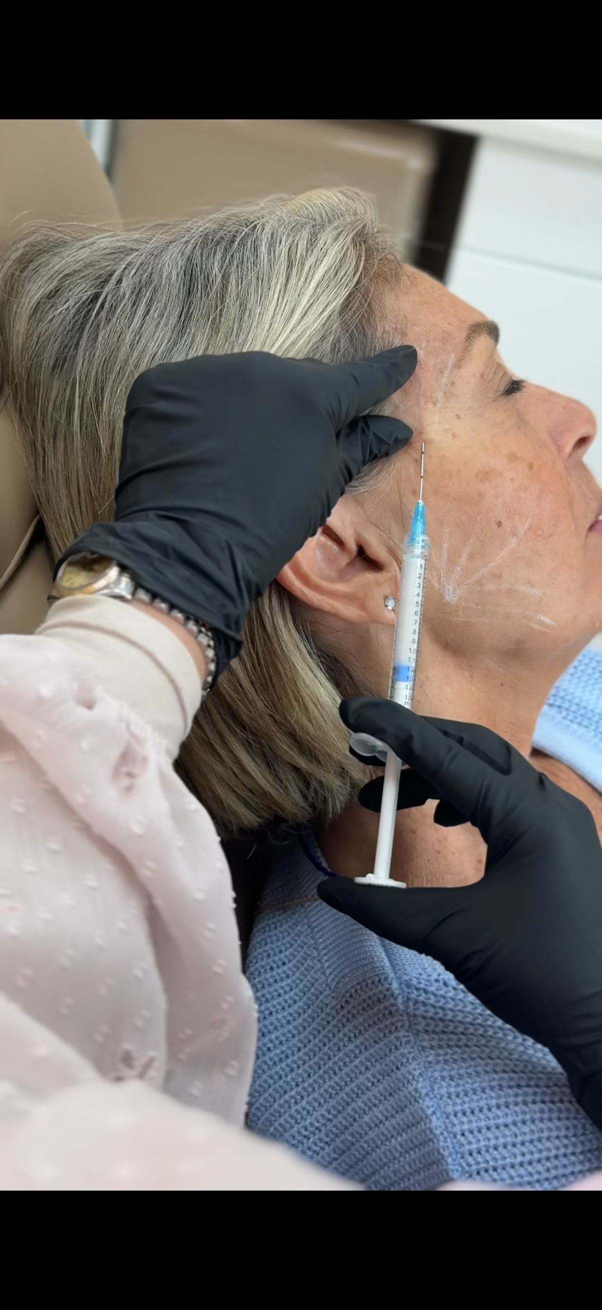 Bioestimulador de colágeno Sculptra em Orlando — EZ Aesthetics & Wellness