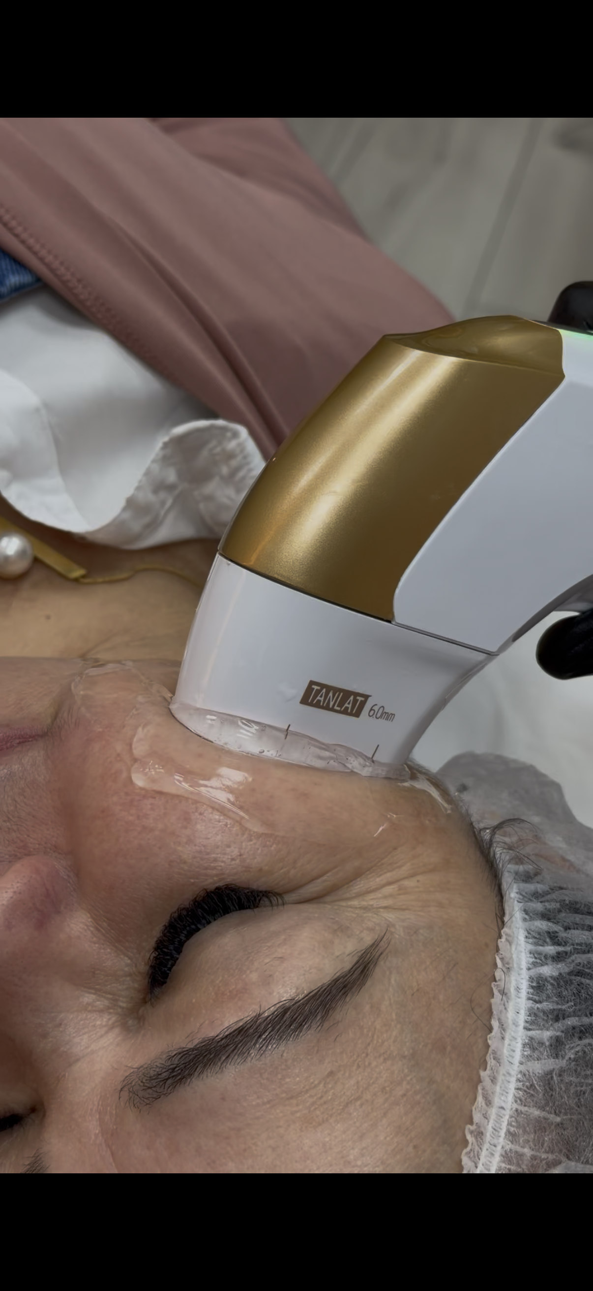 HIFU em Orlando — lifting sem cirurgia com ultrassom microfocado na EZ Aesthetics & Wellness