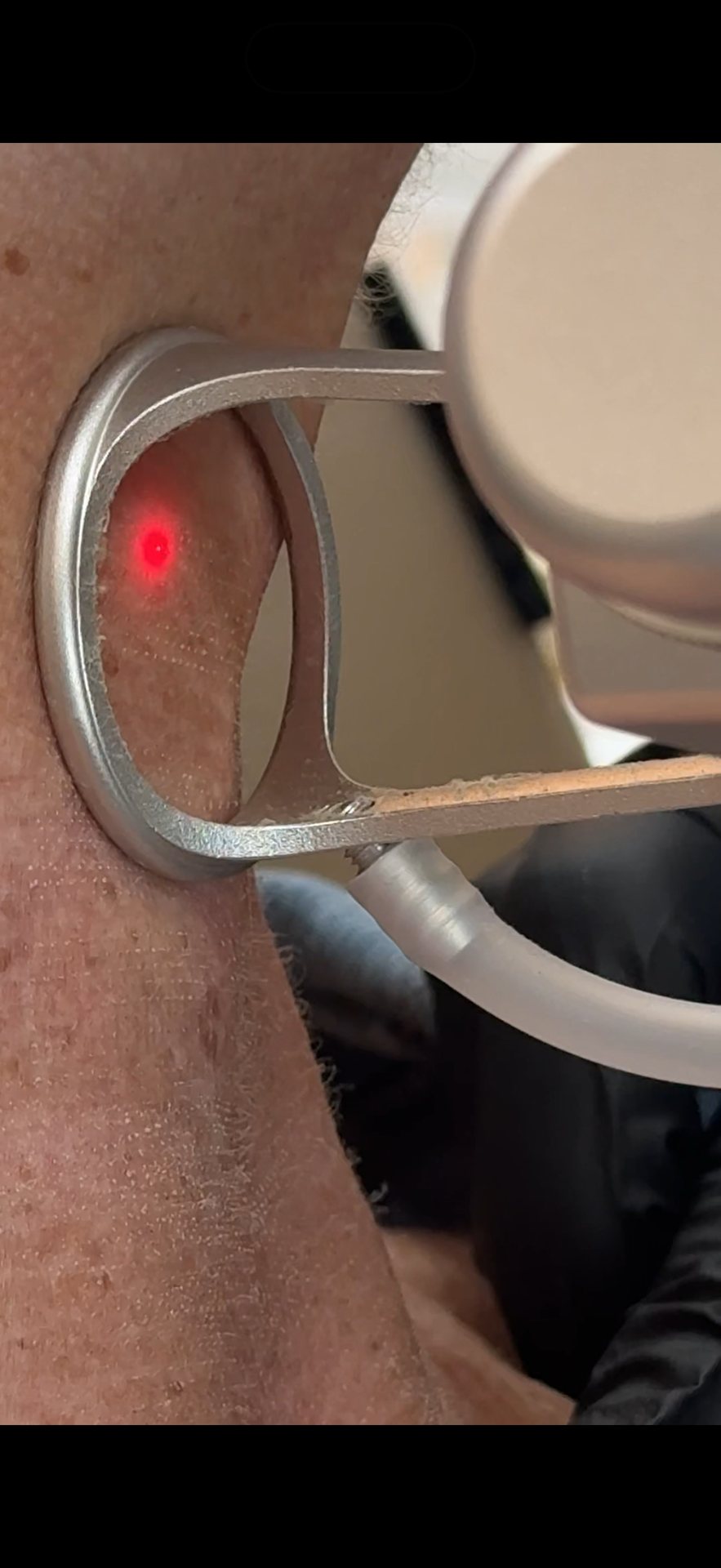 Tratamento a laser em Orlando — EZ Aesthetics & Wellness