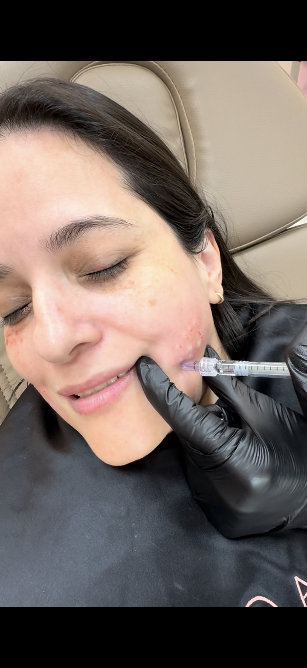 Mesoterapia facial em Orlando — vitaminas e ativos para revitalização da pele